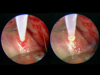 Abb. 5 Lasertherapie einer Teleangiektasie in der Nase