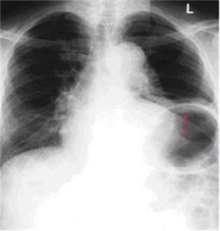 Abb.7: Röntgenbild des Brustkorbes bei Zwerchfelllähmung vor der Operation 