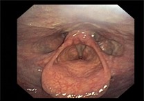 Blick auf den Kehlkopf von ventral. Bild: Prof. E. Stoelben