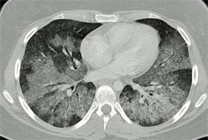 Lungenblutung bei M. Celen