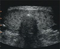 In den drei Abbildungen sieht man im Ultraschallbild die starke Durchblutungsvermehrung einer Basedow Struma. Die zahlreichen schwarzen Flecken entsprechen quer angeschnittenen Blutgefäßen., © Kliniken Köln