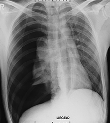 Diese Aufnahme zeigt einen Pneumothorax rechts