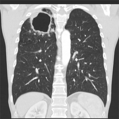 Tuberkulose, Foto: ©Kliniken Köln/ Radiologie