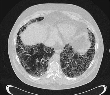 Idiopathische pulmonale Fibrose (IPF), Foto:©Kliniken Köln/ Berger