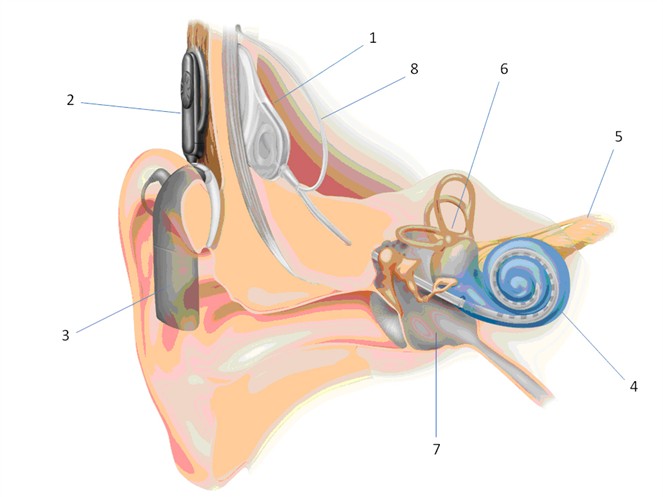 Abbildung eines Cochlear Implants. Graphik: Cochlear Ltd (modizifiert)