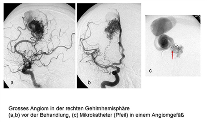 Großes Angiom vor der Behandlung (a, b), Bild C zeigt einen Mikrokatheter (Pfeil) in einem Angiomgefäß