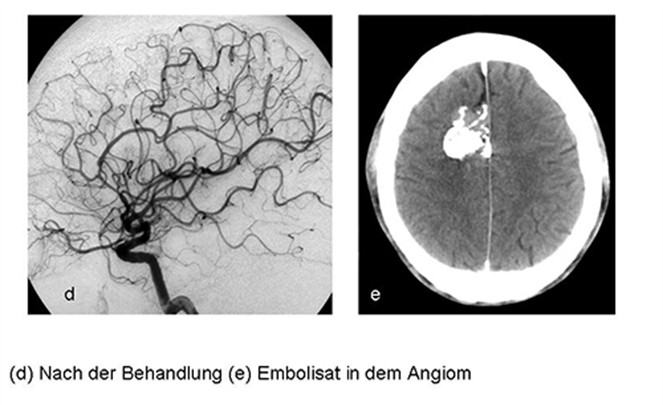 Angiom nach der Behandlung. Bild e zeigt Embolisat in dem Angiom.